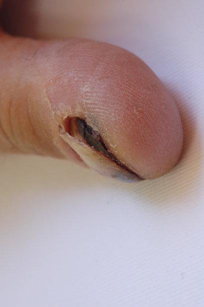 指甲损失图片下载