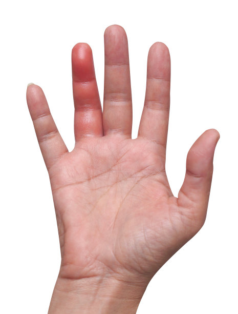 亚洲妇女手掌右与红肿从蜜蜂蛰在姐妹手指，皮肤炎症过敏孤立在白色背景与剪切路径图片下载