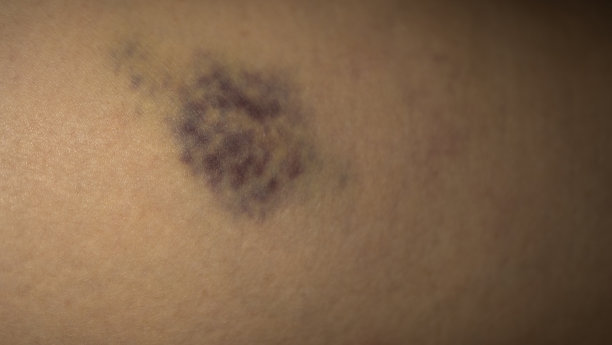 一个女人的腿上有一个很大的黑色血肿图片下载