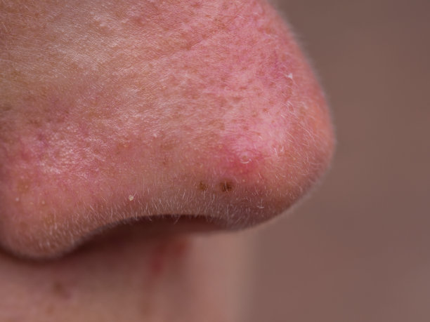 一个年轻女人的红鼻子图片下载