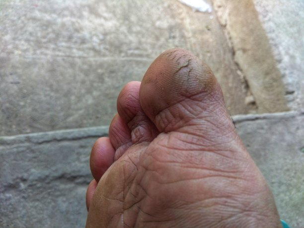 因真菌病造成的鞋底破裂。不卫生导致脚不健康图片下载