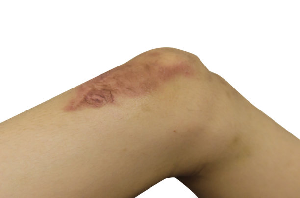 烫伤的腿图片下载