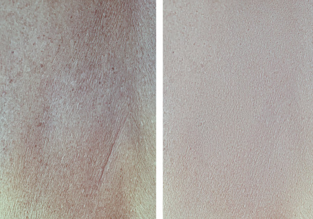 治疗前后皮肤起皱图片下载