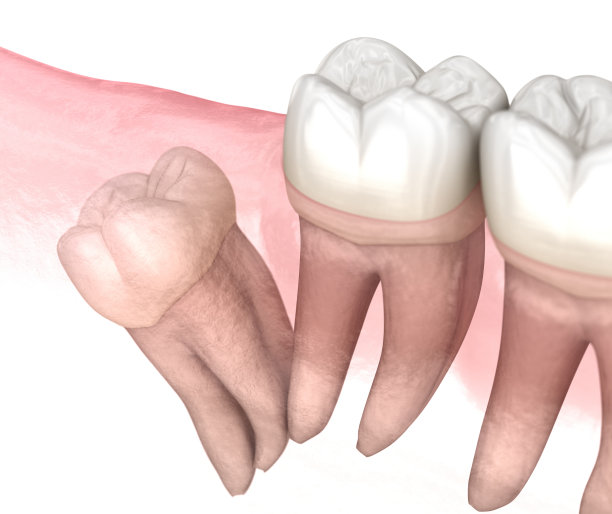 智齿远端嵌顿。医学上准确的牙齿3D插图图片下载