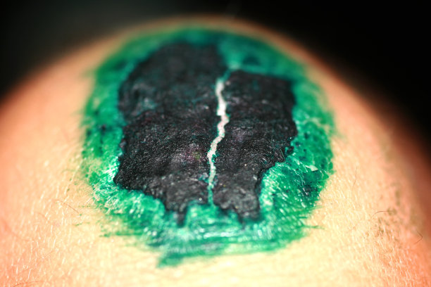 膝盖上的伤口正在愈合。伤口愈合后呈鲜绿色。痂会爬升图片下载