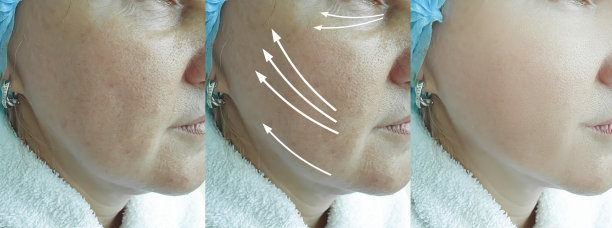 老年妇女脸部皱纹治疗前后箭头图片下载