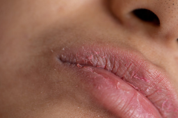 临床干燥嘴唇的背景。图片下载