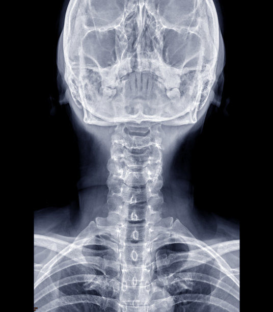 颈椎平片或颈椎正位片诊断椎间盘突出。图片下载