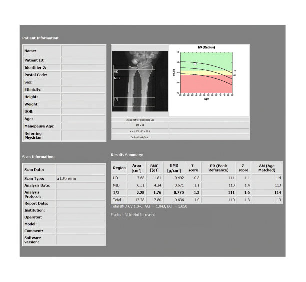 DEXA密度测量报告腰椎手腕关节扫描骨质减少，经常是骨质疏松的前兆。图片下载