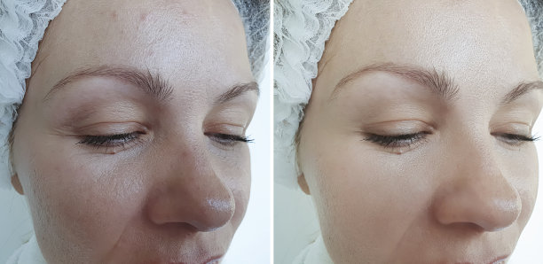 女人脸部皱纹治疗前后拼贴素材图片