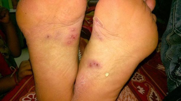 皮肤感染图片下载