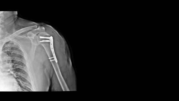 肩关节x线片显示肩关节骨折(肱骨颈骨折)采用钢板器械切开复位内固定(ORIF)治疗。医疗技术的概念。图片下载