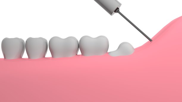智齿移除，3d渲染，白色背景图片下载