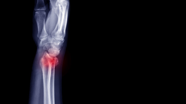 腕关节x线片显示车祸导致前臂骨折(桡骨远端骨折)。突出破碎部位和疼痛部位。医学影像和技术概念图片下载