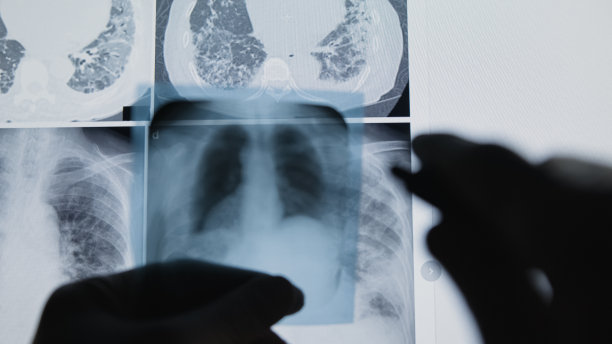 医生在手术室检查病人的肺部x光片。医学概念。图片下载