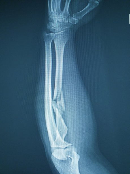 前臂骨折。图片下载