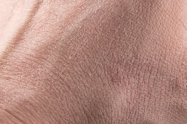 手皮肤干裂图片下载