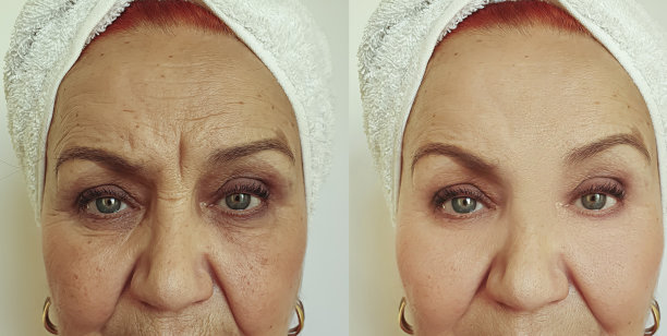 老年妇女脸部皱纹治疗前后图片下载