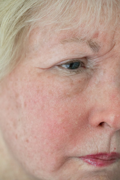 皮肤过敏图片下载