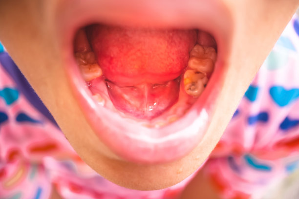 儿童龋齿，儿童龋齿的特写镜头。、叠门牙，有问题的孩子，家长应带去看牙医。图片下载