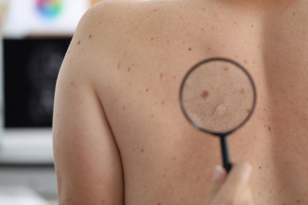 医生检查痣的微距镜头图片下载