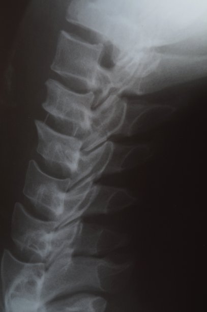 人体脊柱的磁共振成像。脊柱x光片，侧视图。颈椎侧位x线片，用C6/7椎弓根螺钉和棒棒固定图片下载