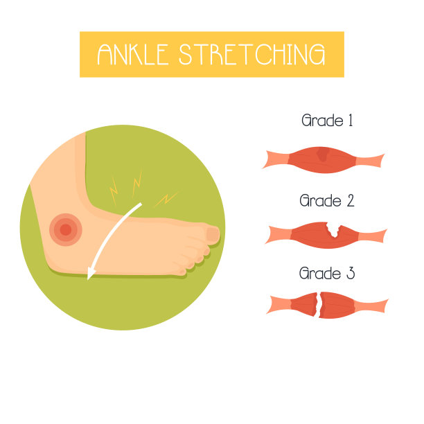 解剖矢量插图在一个平坦的风格的踝关节伸展和它的等级。运动损伤图片下载