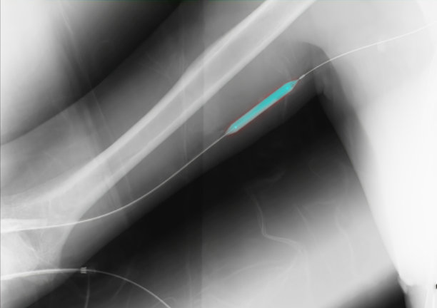 右臂血管成形术、球囊血管成形术及经皮腔内血管成形术(PTA)。图片下载