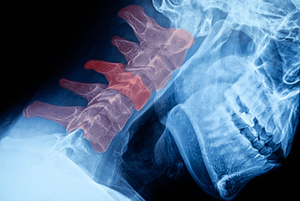 颈部x光片图片下载