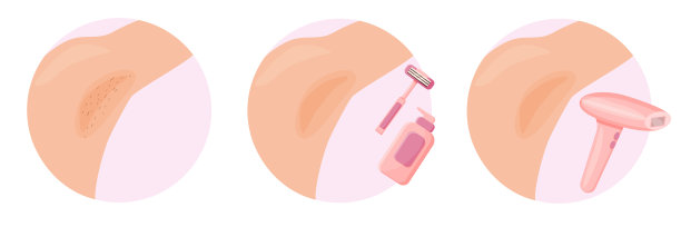 脱毛与腋毛脱毛方法不同。图片下载