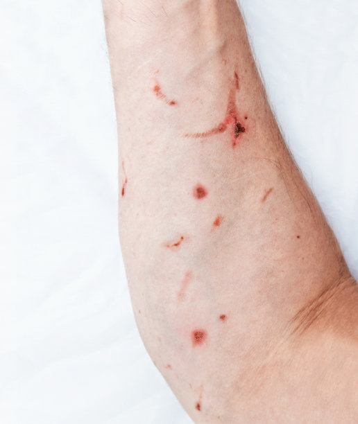 一个人的手因焊接而热烧伤图片下载