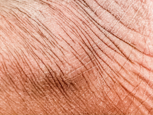 冬季皮肤干燥图片下载