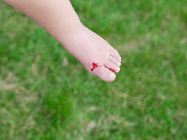 这孩子的腿受了伤。那个女孩为她的孩子提供急救。那个女孩伤了腿。腿上的伤口。受伤到流血。婴儿脚上的血图片下载