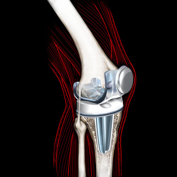 膝关节假体替代受损的膝盖骨关节图片下载