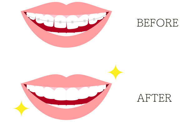 美容牙科和正畸插图:扭曲和美丽的牙齿排列，与金属支架图片下载