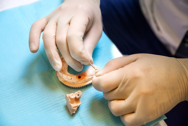 牙科医生用螺钉固定人工牙齿图片下载