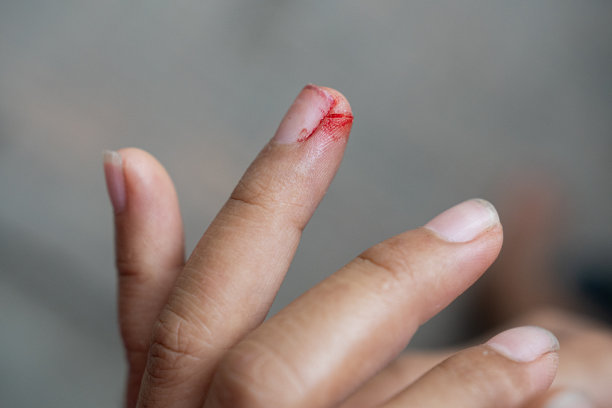 女人手指上刀伤上的血迹。图片下载