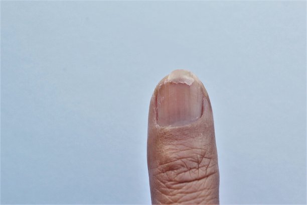 断拇指指甲照片图片下载