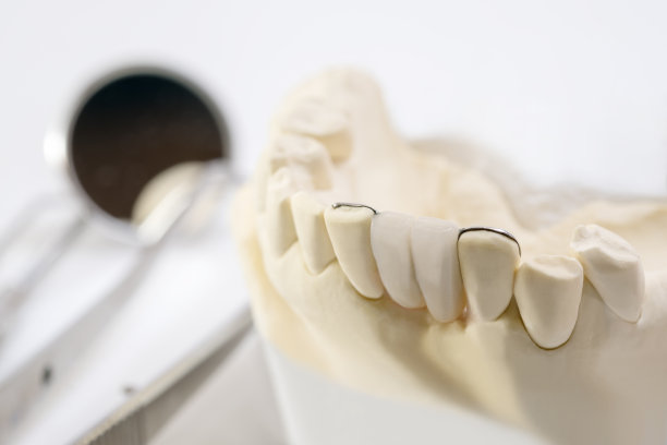 牙科马里兰桥图片下载