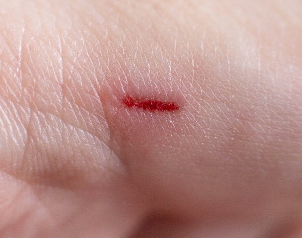 深的伤口，手指上的抓痕，背景，宏观，血图片下载