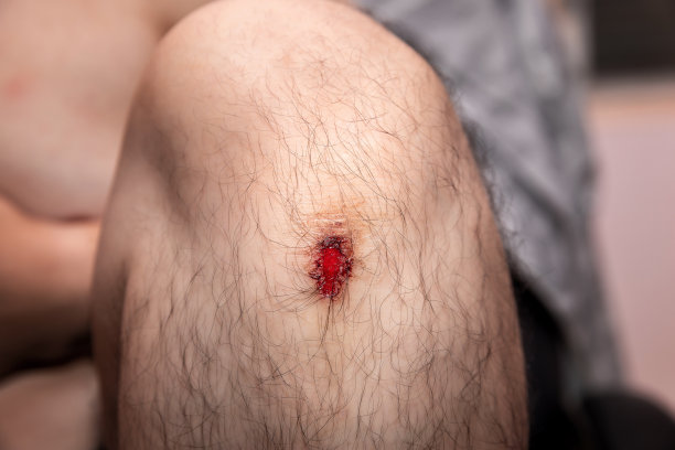 一个男人膝盖上的新伤口的特写。图片下载