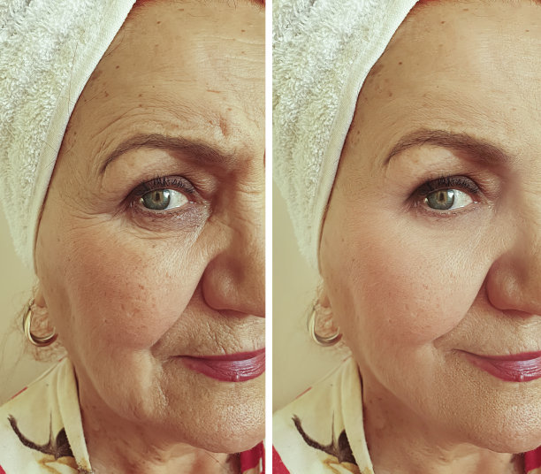 皱纹面老妇治疗前后图片下载