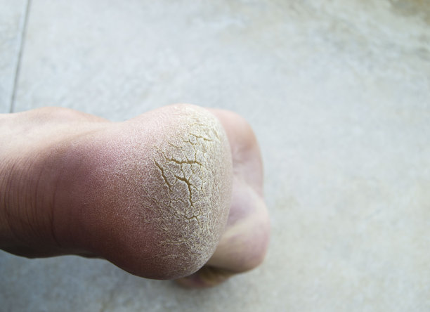 皮肤病，脚后跟裂缝，人们脚后跟的裂缝，素材图片