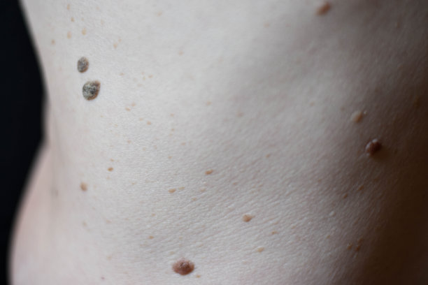 女性背部皮肤上的黑色胎记和痣图片下载