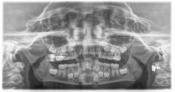 儿童的全景x光牙图片下载
