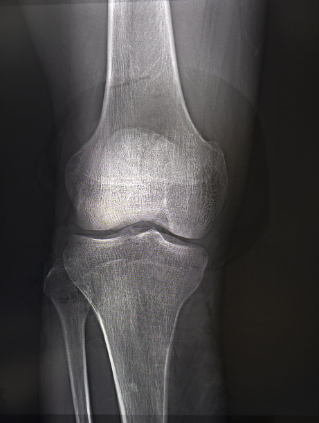 膝关节x光片近距离观察。医学图片下载