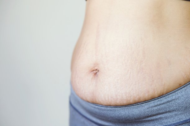 孕妇腹部皮肤造成条纹状脂肪和疤痕图片下载