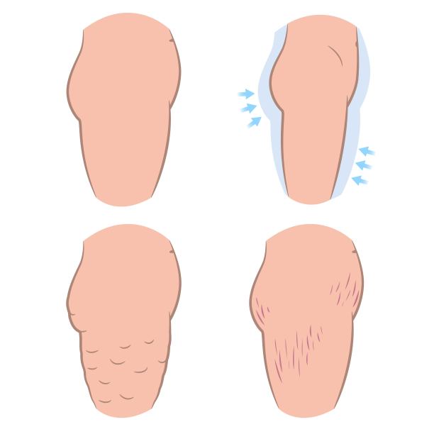 臀部肥胖，脂肪团和条纹图片下载