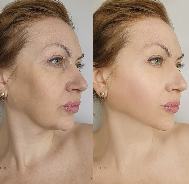 女性面部皱纹治疗前后素材图片