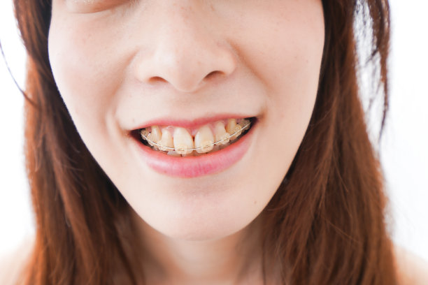 年轻女子戴矫正牙套图片下载